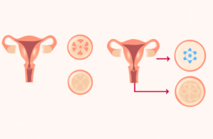 Why a Special Calculator is Needed After IVF
